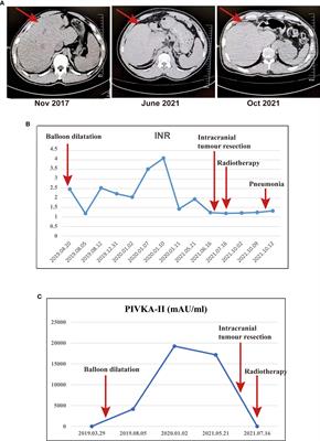 Rhabdoid meningioma with a history of Budd-Chiari syndrome: a case report and review of the literature